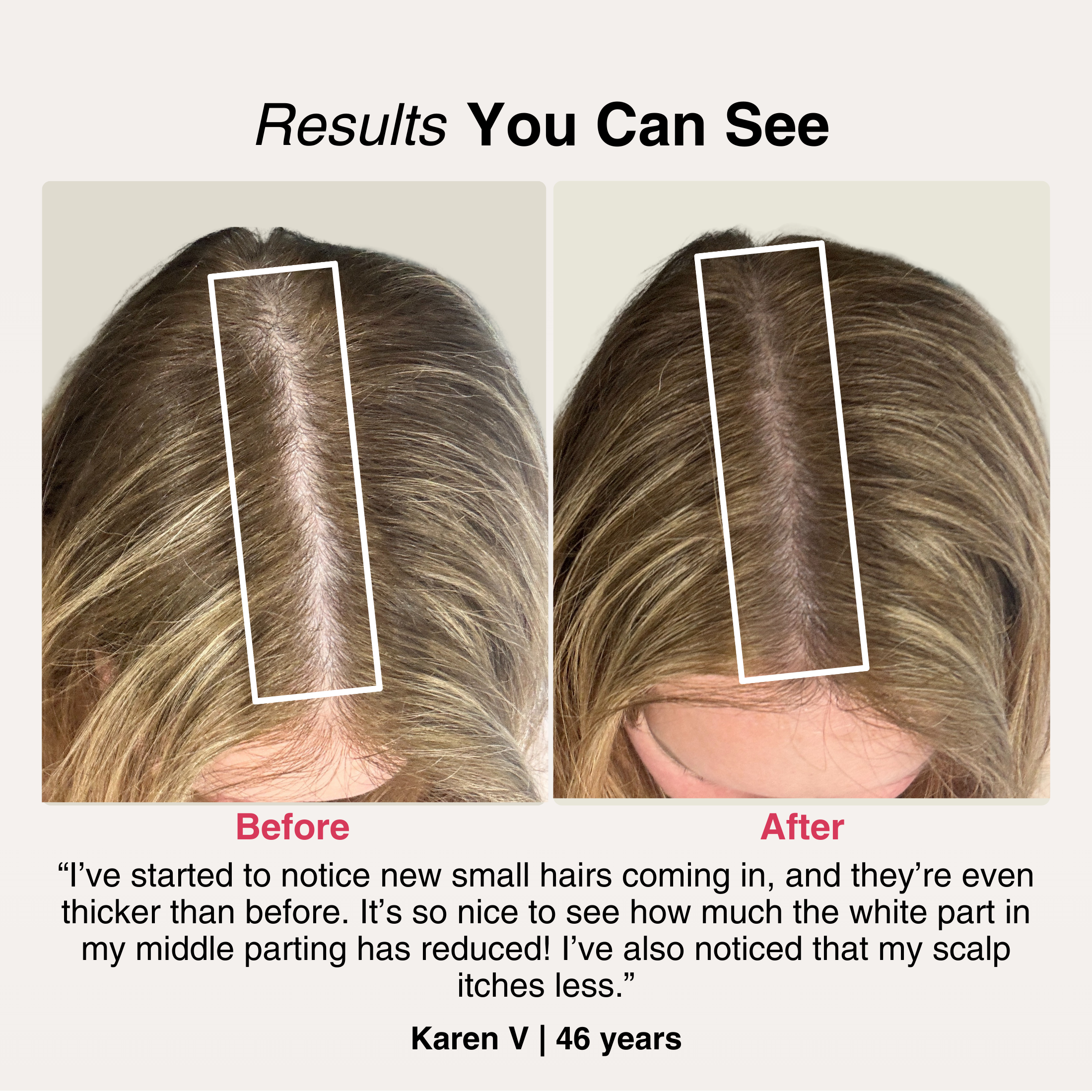TheraCapX® Hair Growth System