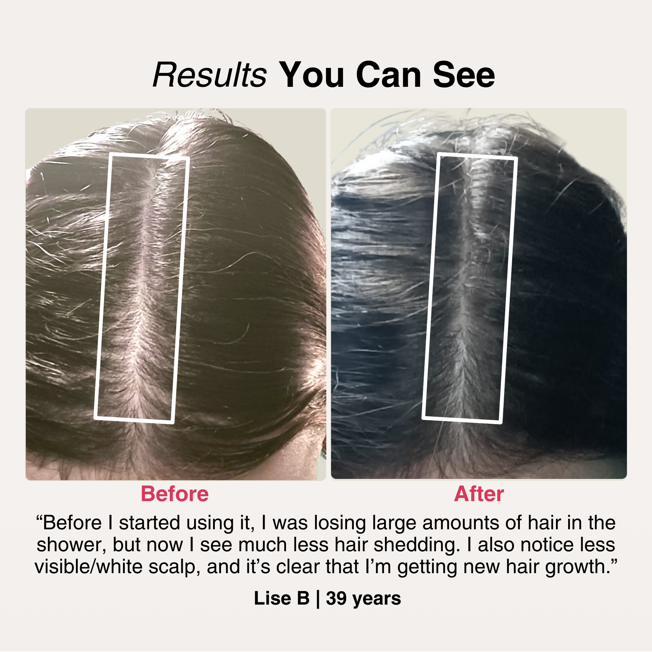 TheraCapX® Hair Growth System
