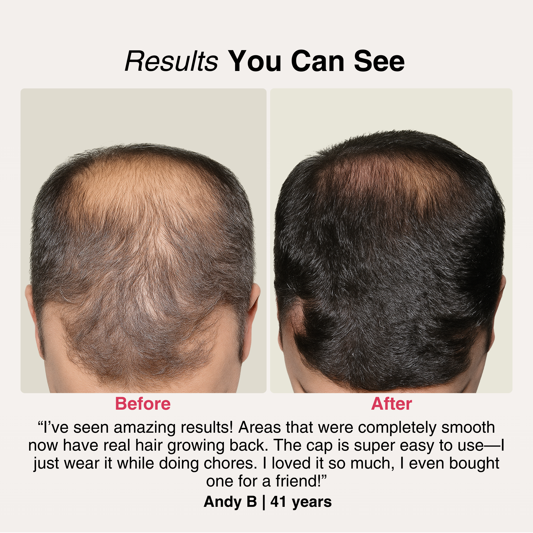 TheraCapX® Hair Growth System